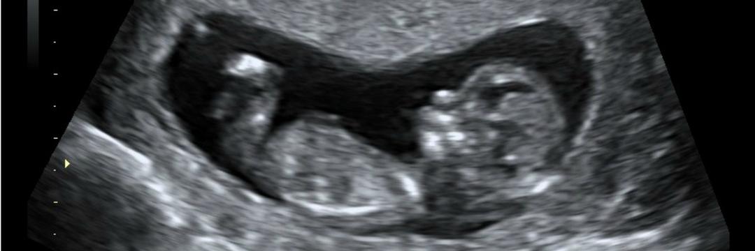 O bebê invisível: quando um aborto acontece
